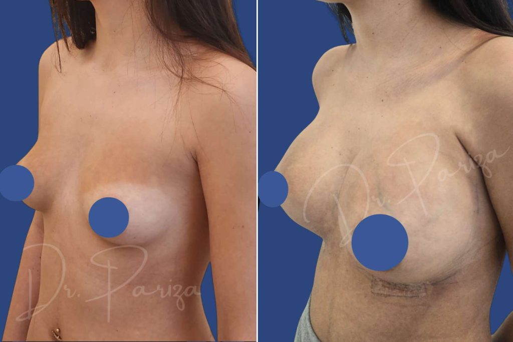 Breast Augmentation - CASE 1