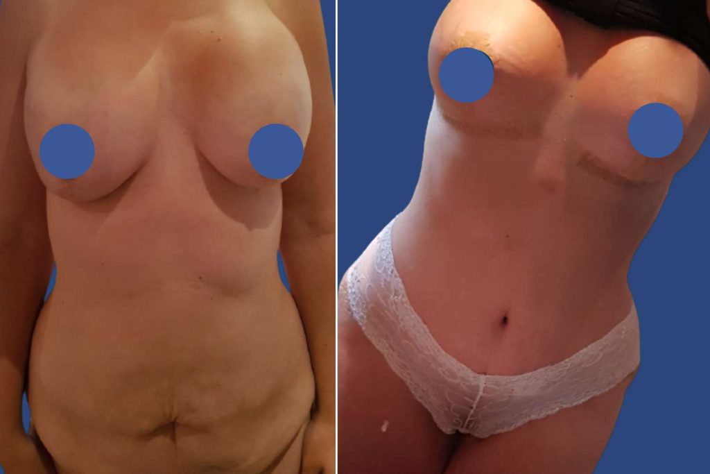 Breast Augmentation - CASE 5