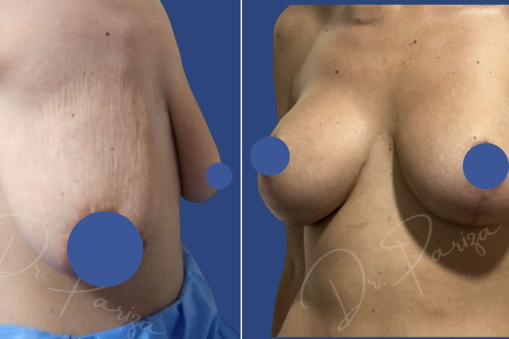 Breast Augmentation - CASE 6