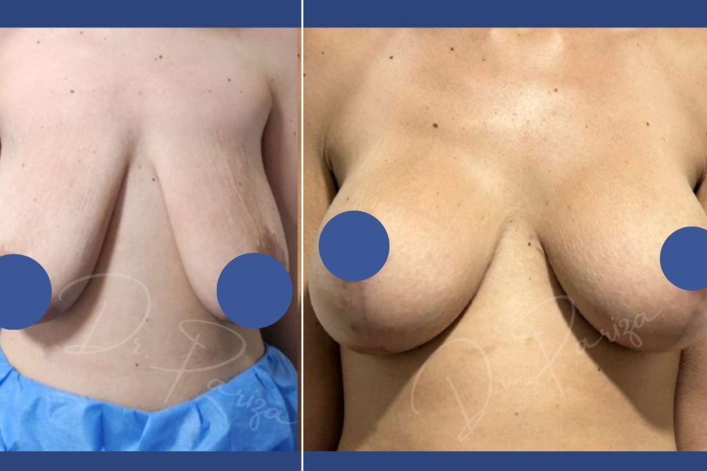 Breast Augmentation - CASE 6