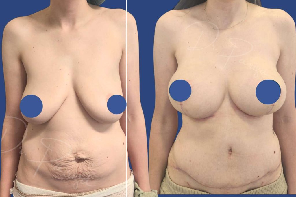 Breast Augmentation - CASE 7