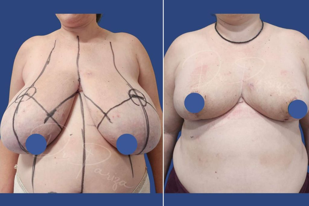 Breast Reduction - CASE 1