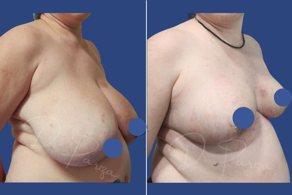 Breast Reduction - CASE 1