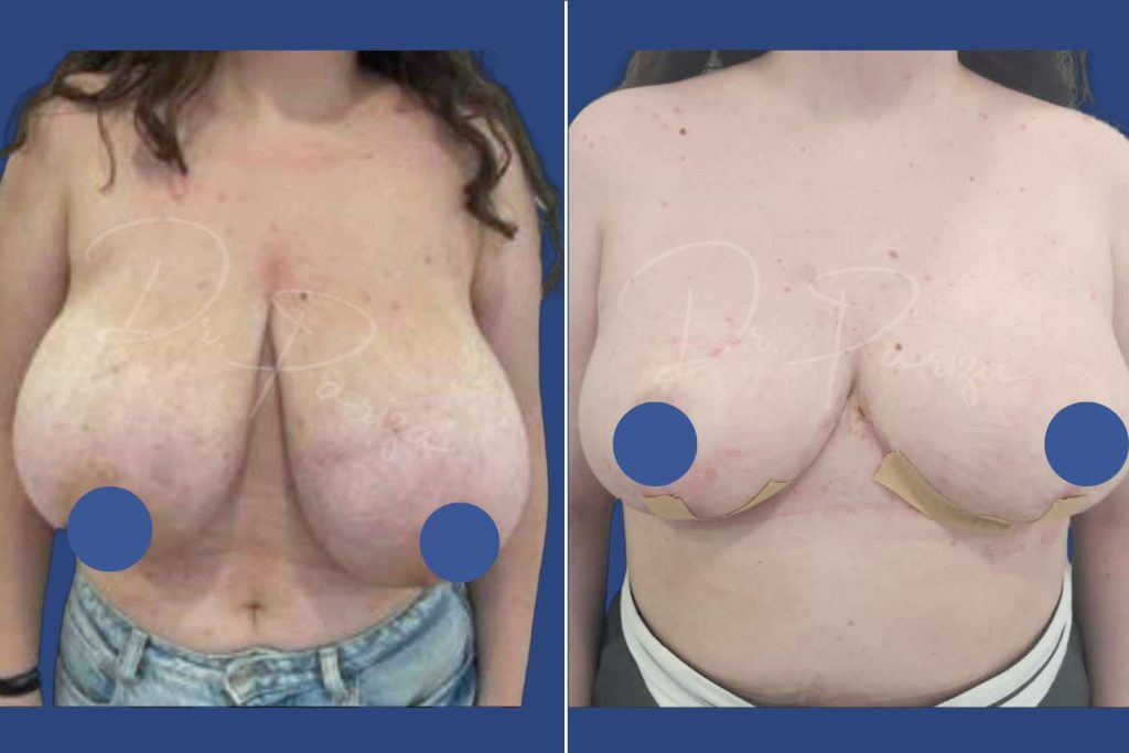 Breast Reduction - CASE 2