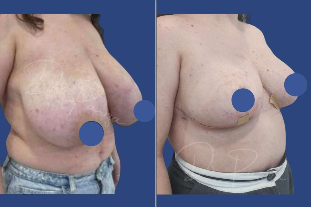Breast Reduction - CASE 2