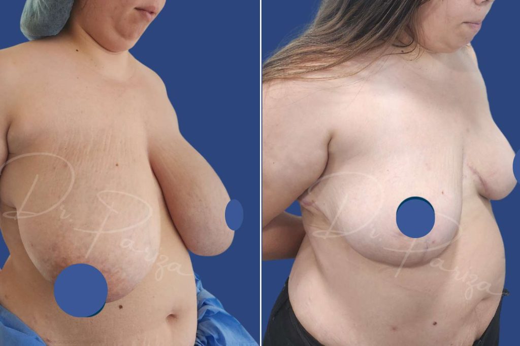Breast Reduction - CASE 3