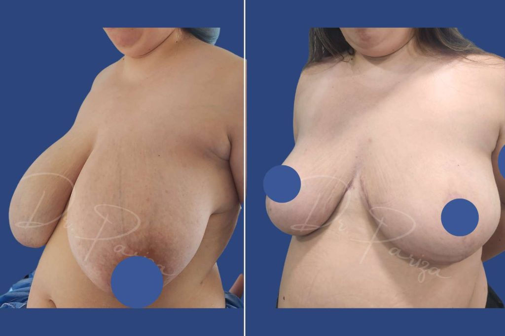 Breast Reduction - CASE 3