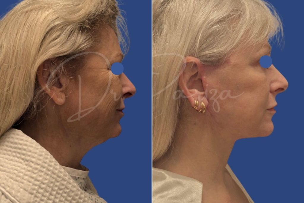 Facelift - CASE 4