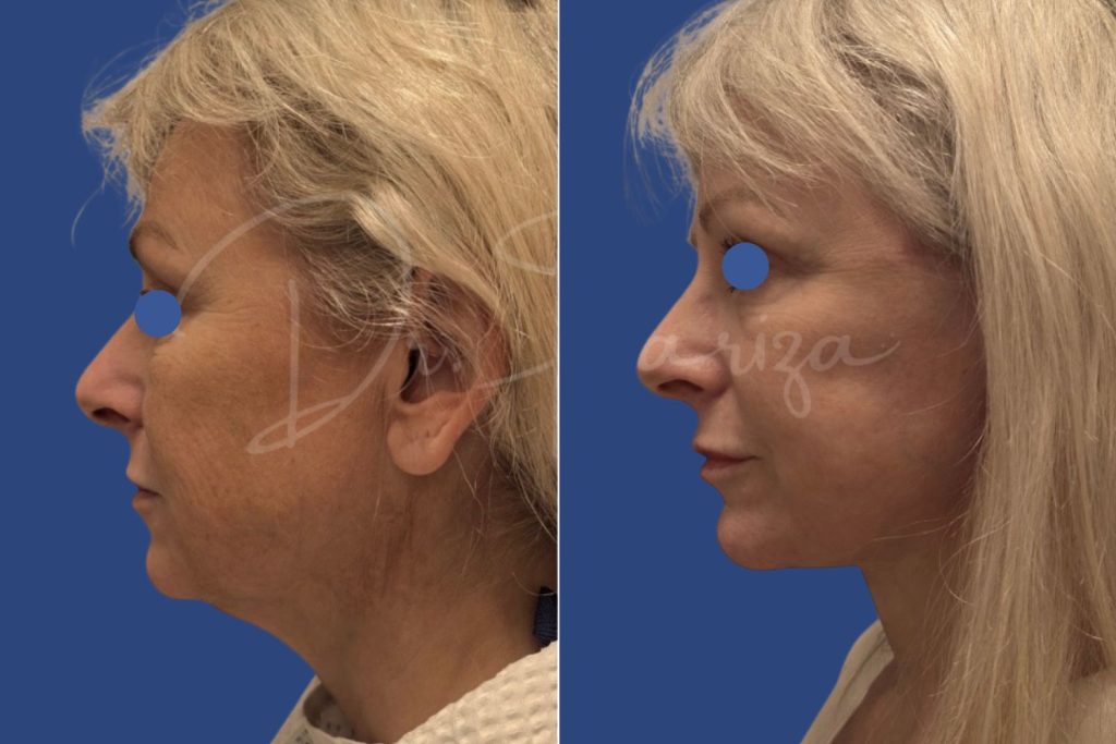 Facelift - CASE 4