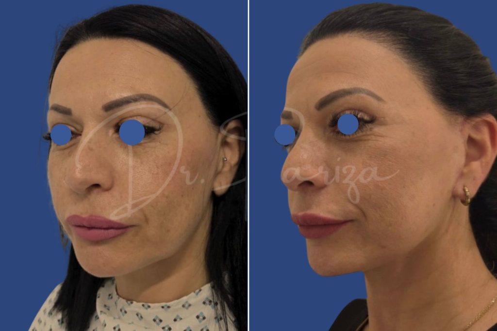 Facelift - CASE 5