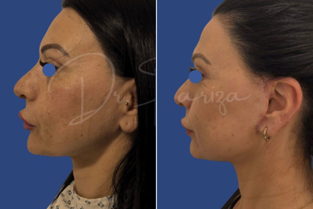 Facelift - CASE 5