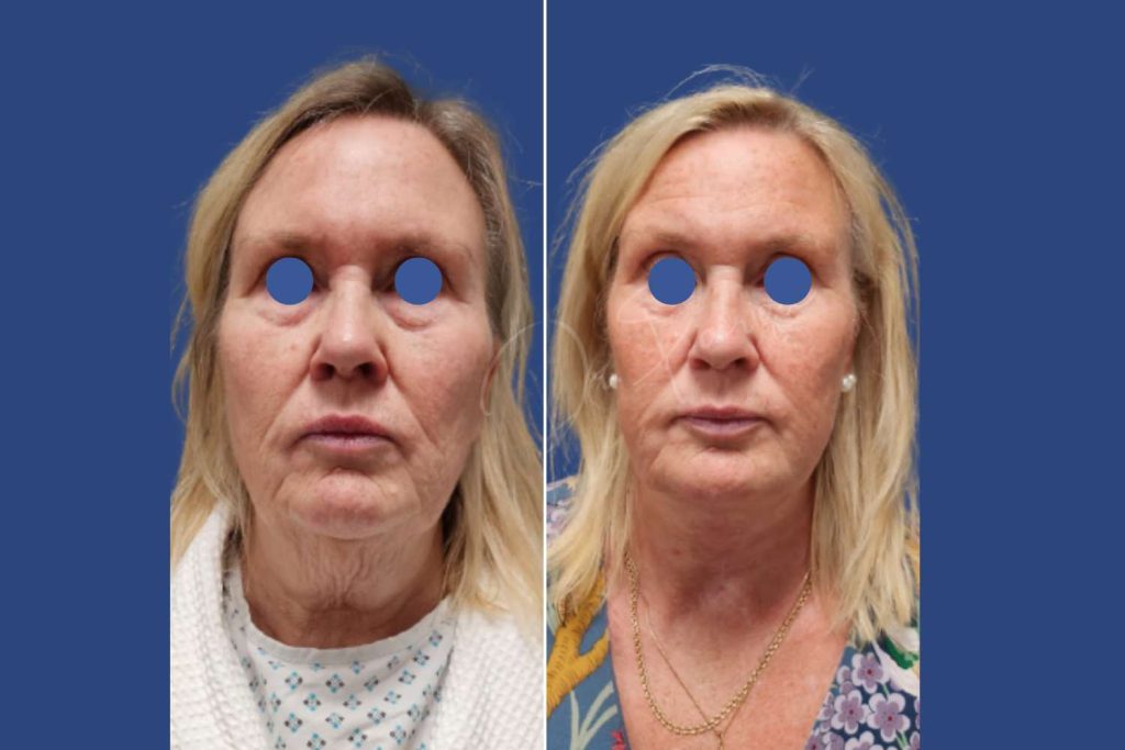 Facelift - CASE 1