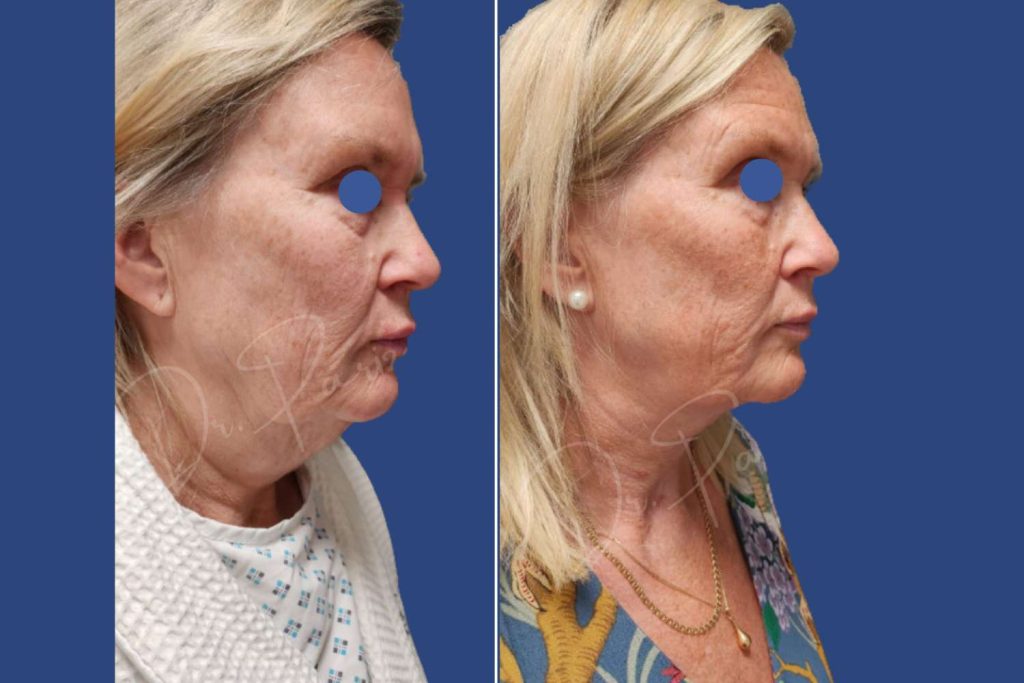 Facelift - CASE 1