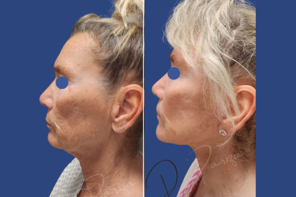 Facelift - CASE 2