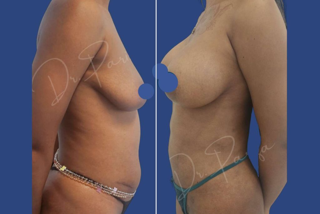 Abdominoplasty (Tummy Tuck) - CASE 1