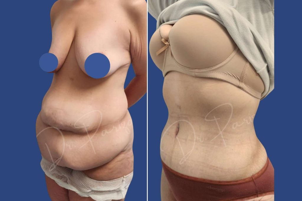 Abdominoplasty (Tummy Tuck) - CASE 2