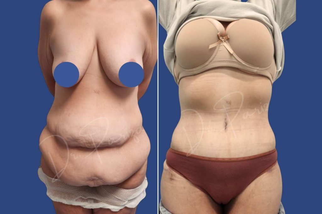 Abdominoplasty (Tummy Tuck) - CASE 2