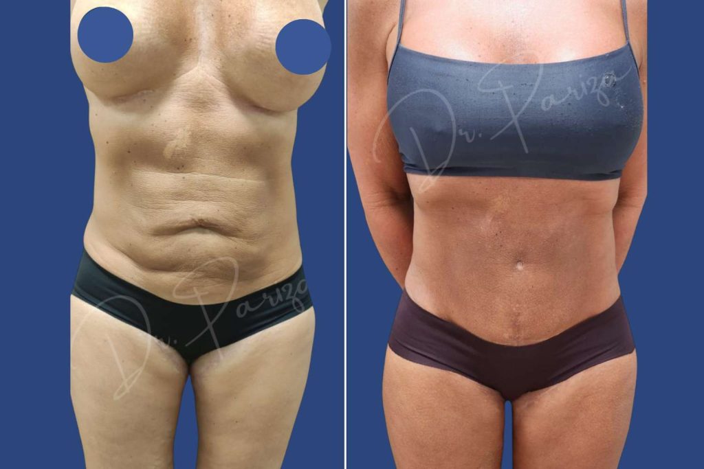 Abdominoplasty (Tummy Tuck) - CASE 3