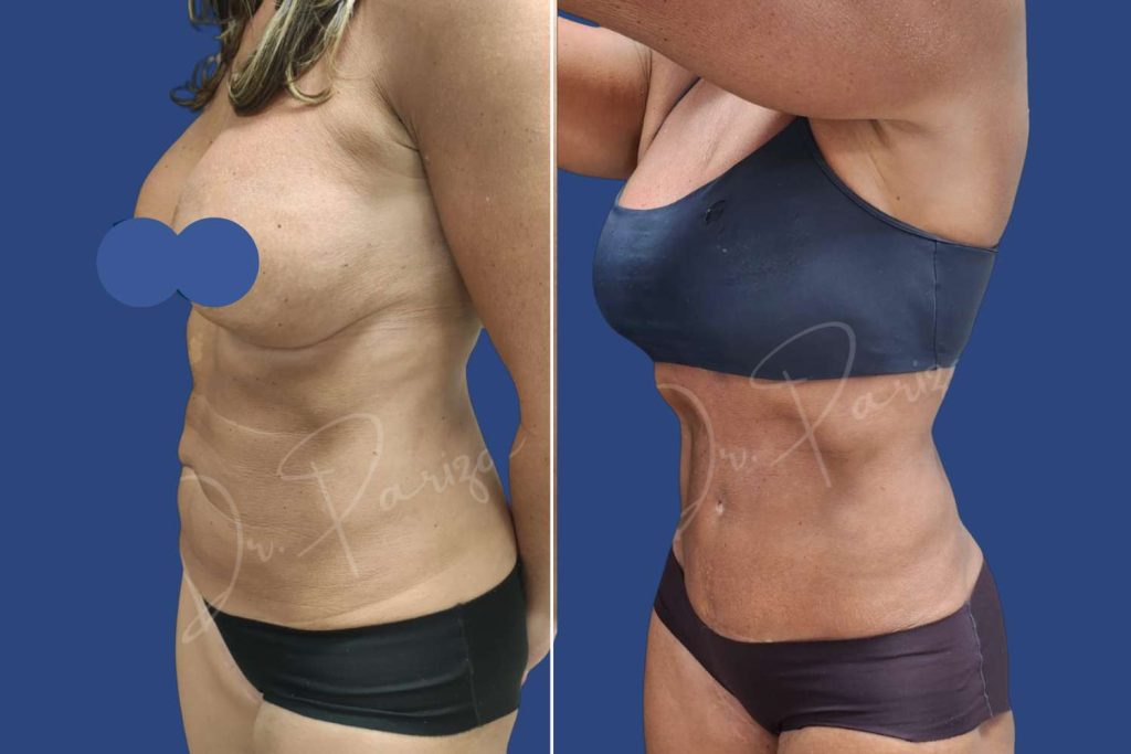 Abdominoplasty (Tummy Tuck) - CASE 3