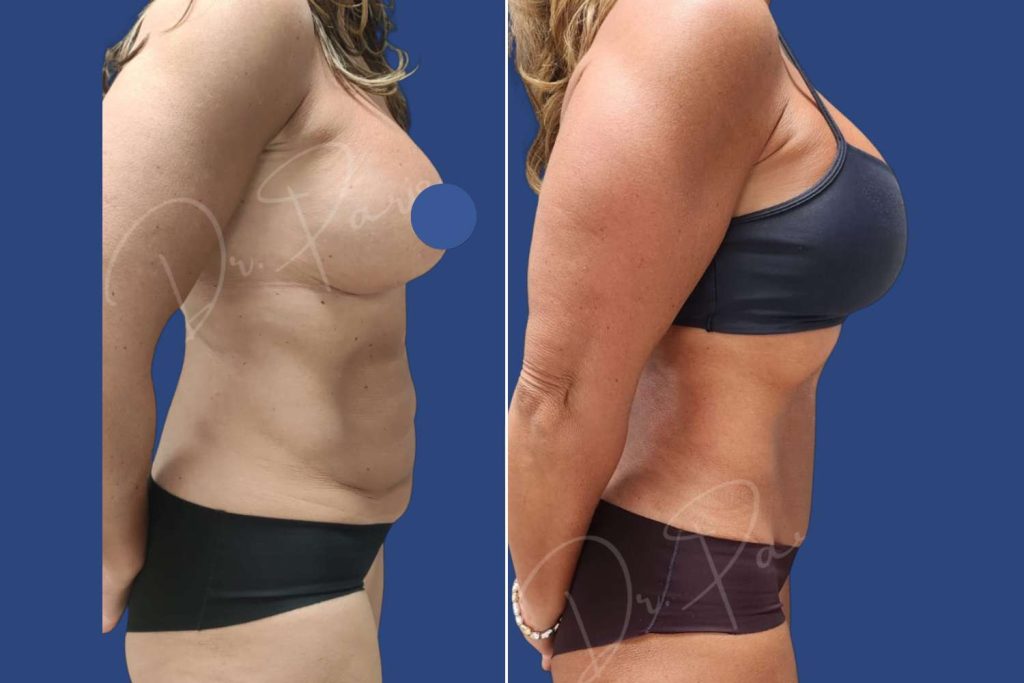 Abdominoplasty (Tummy Tuck) - CASE 3