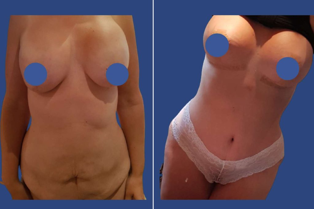 Abdominoplasty (Tummy Tuck) - CASE 4