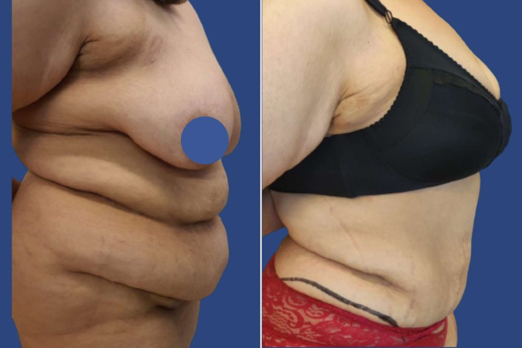 Abdominoplasty (Tummy Tuck) - CASE 5