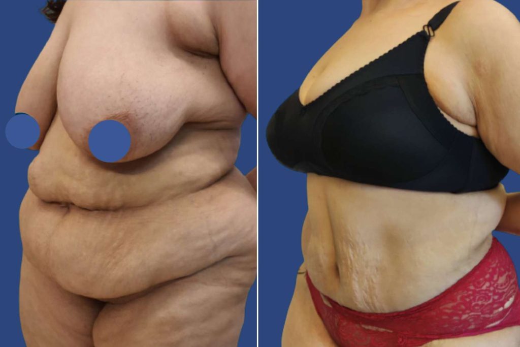 Abdominoplasty (Tummy Tuck) - CASE 5