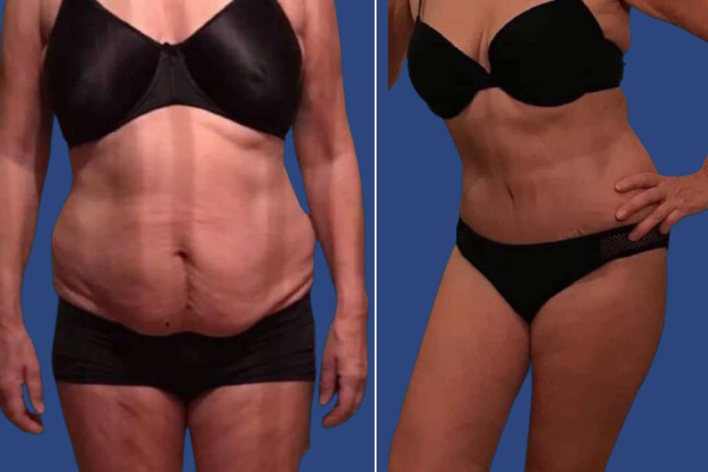 Abdominoplasty (Tummy Tuck) - CASE 6